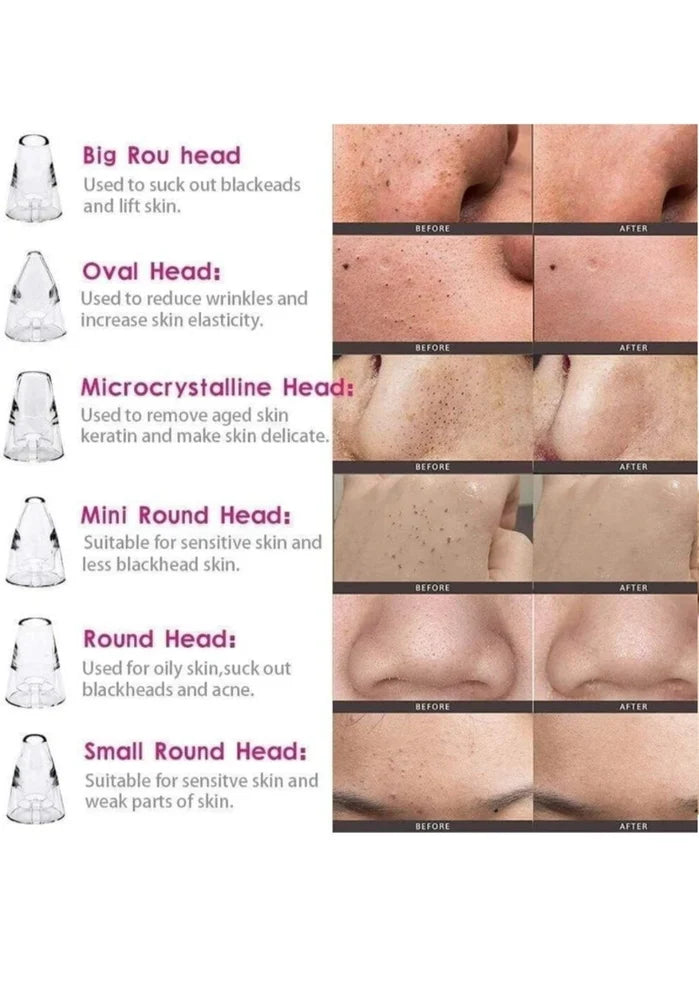 Blackhead Remover – Pore Vacuum Cleaner